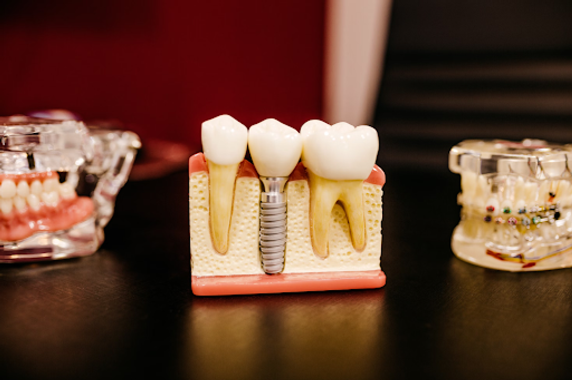 How Much Do Dental Implants Cost?